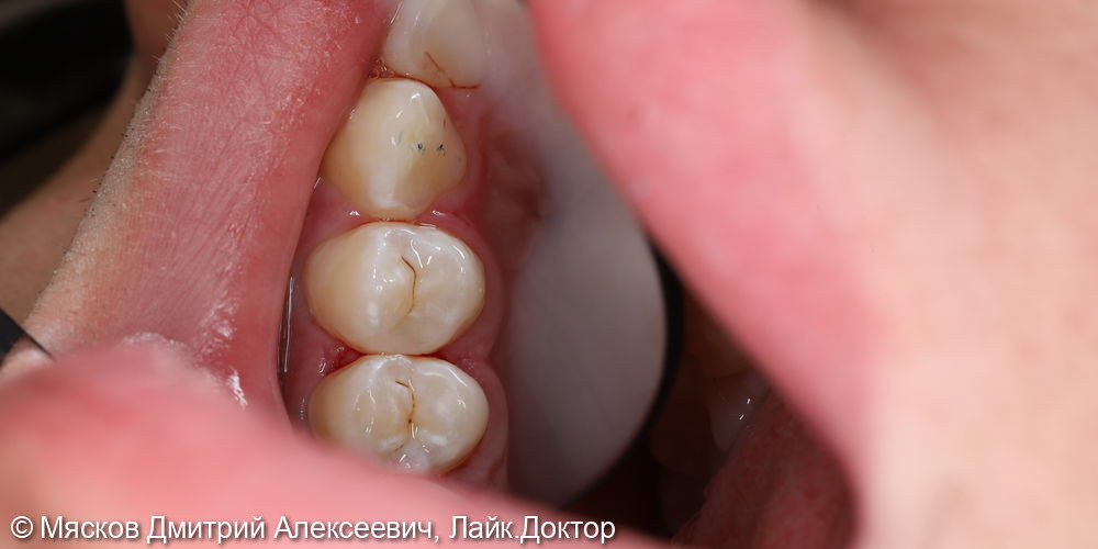 Лечение кариеса 2.4 зуба фото 4 · Ярославль