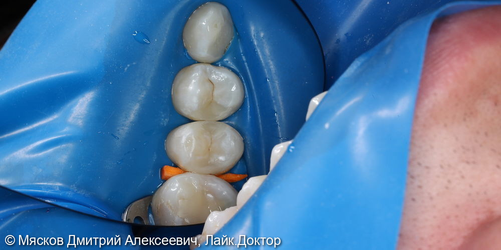Лечение кариеса 2.4 зуба фото 5 · Ярославль