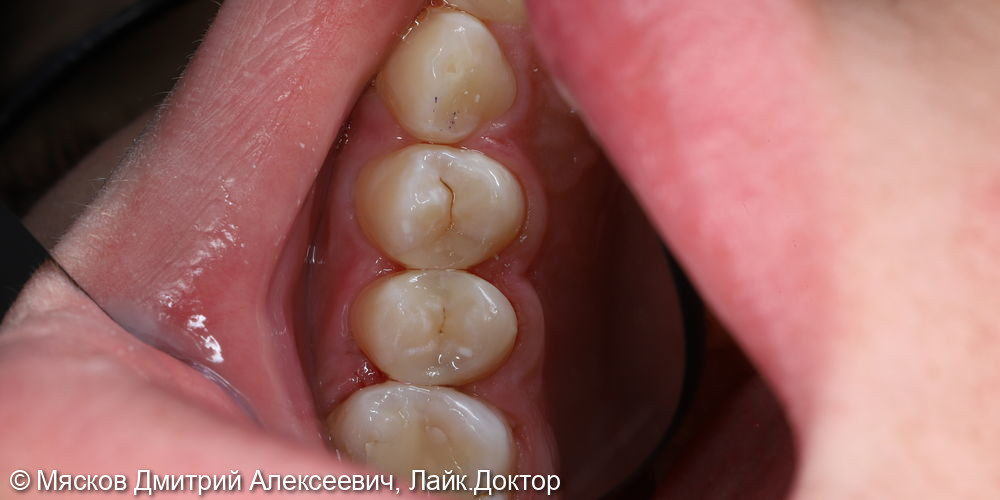 Лечение кариеса 2.4 зуба фото 6 · Ярославль