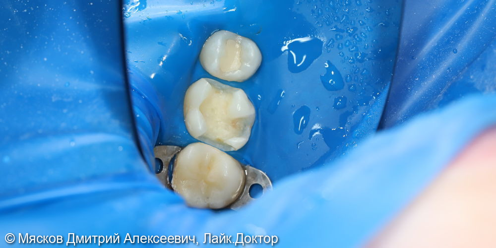 Замена пломбы на 2.6 зубе - после
