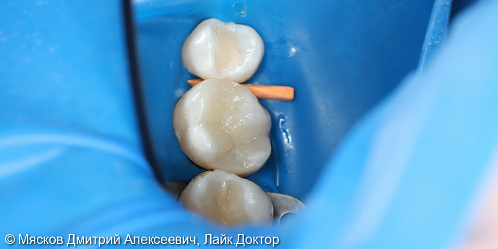 Замена пломбы на 2.6 зубе фото 3 · Ярославль