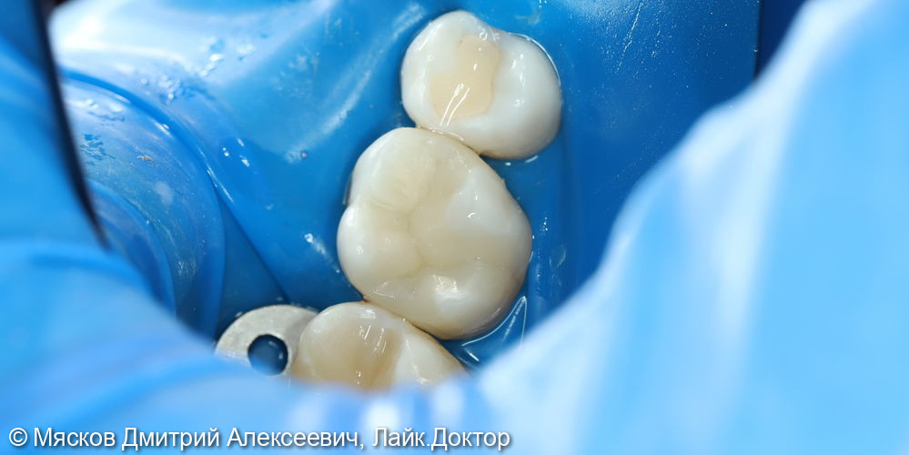 Замена пломбы на 2.6 зубе фото 4 · Ярославль