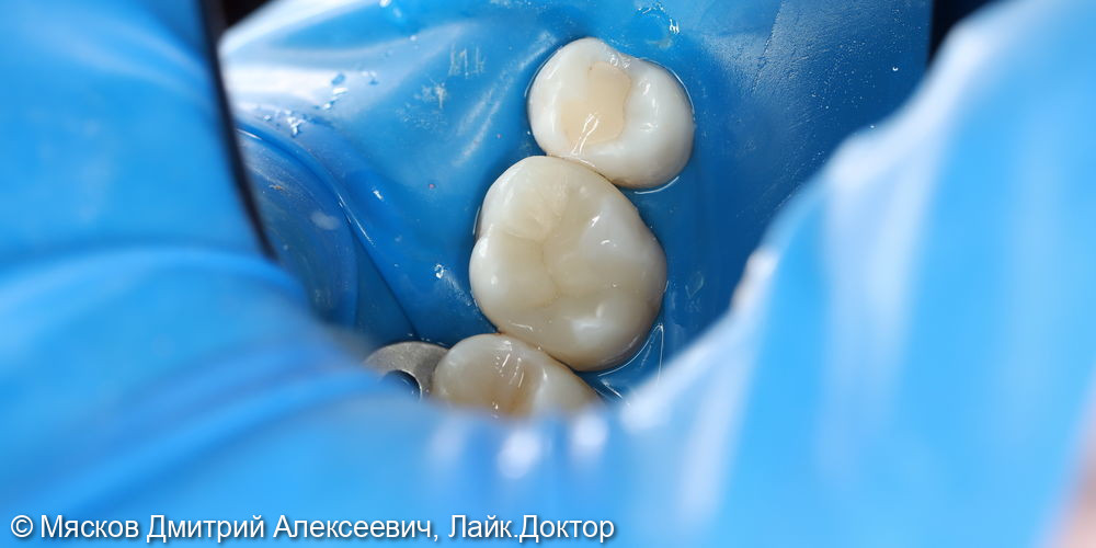 Замена пломбы на 2.6 зубе фото 5 · Ярославль