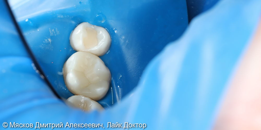 Замена пломбы на 2.6 зубе фото 6 · Ярославль