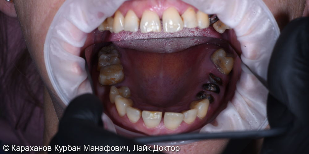 Профессиональная гигиена полости рта и лечение породонтита - фото №2