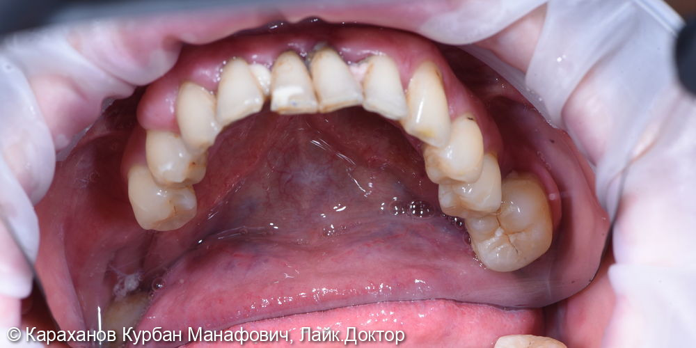Профессиональная гигиена полости рта и лечение породонтита - фото №3