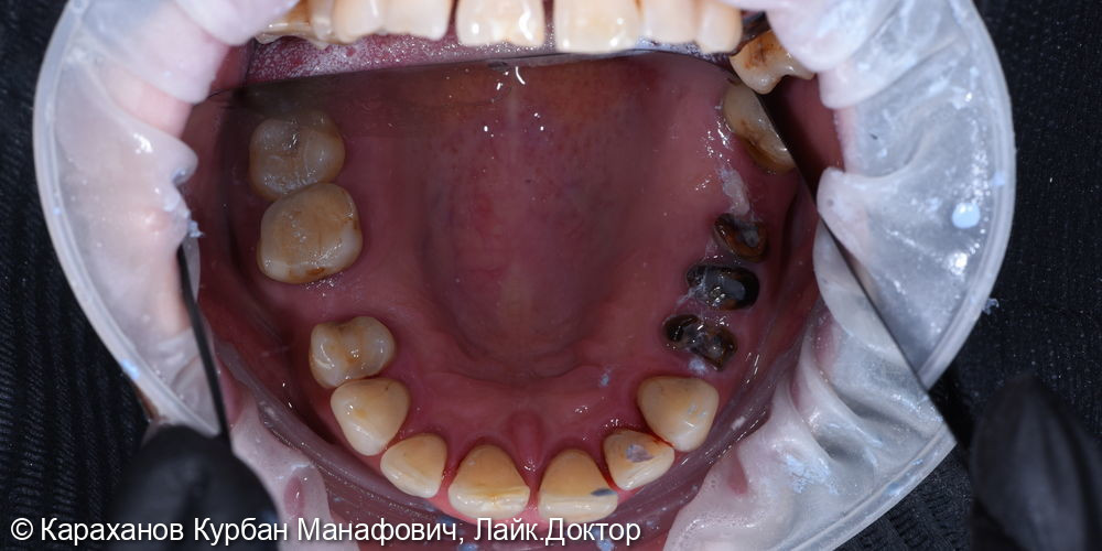 Профессиональная гигиена полости рта и лечение породонтита - фото №6