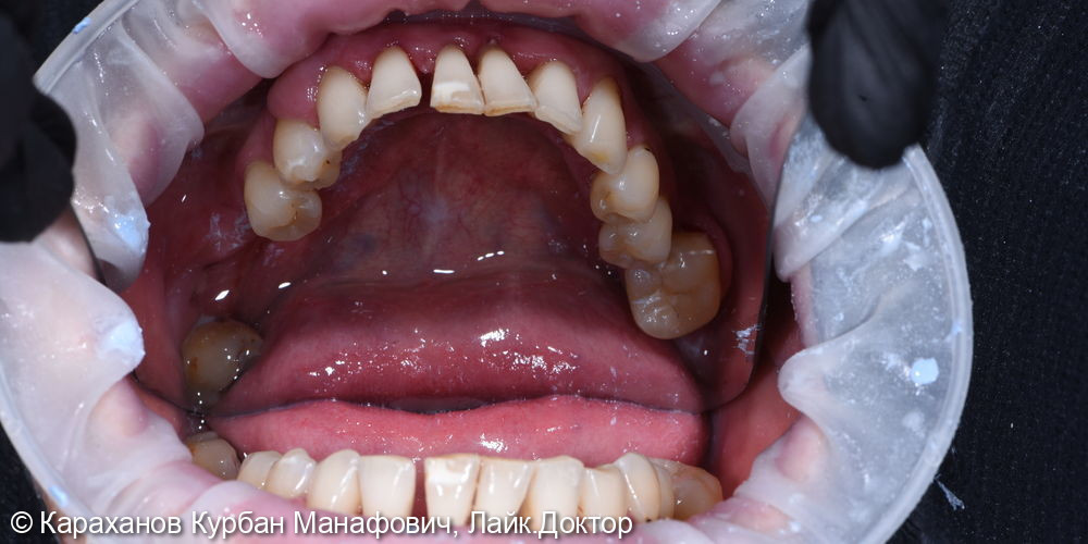 Профессиональная гигиена полости рта и лечение породонтита - фото №7