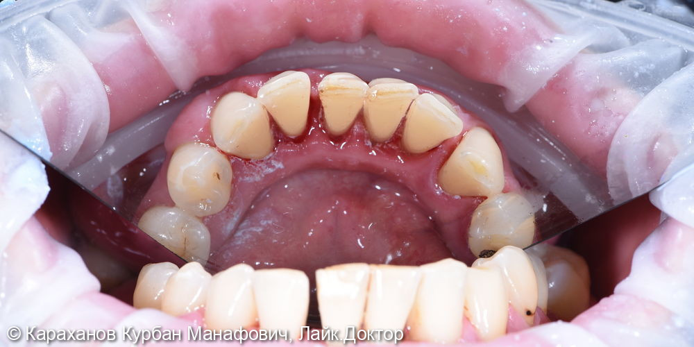 Профессиональная гигиена полости рта и лечение породонтита - фото №8