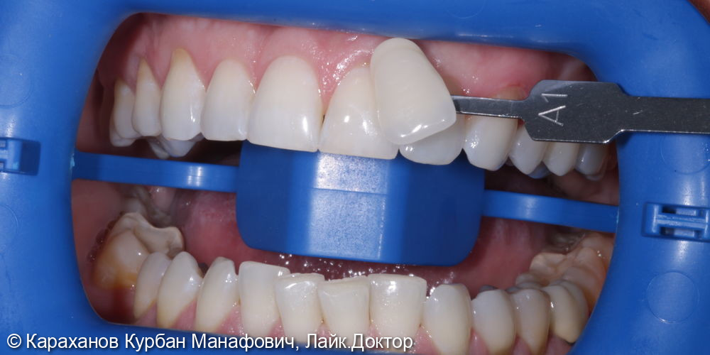 Офисное отбеливание зубов с применение аппаратуры ZOOM 4 - фото №1