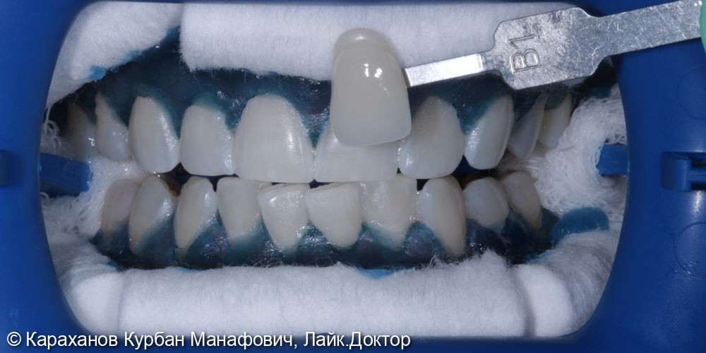 Офисное отбеливание зубов с применение аппаратуры ZOOM 4 - фото №2