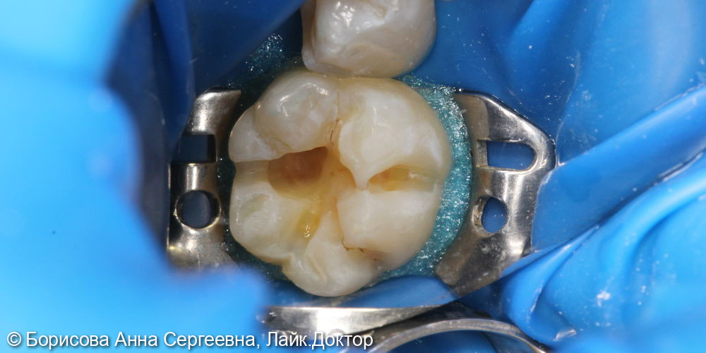 Лечение кариеса зуба 3.6 - фото №2