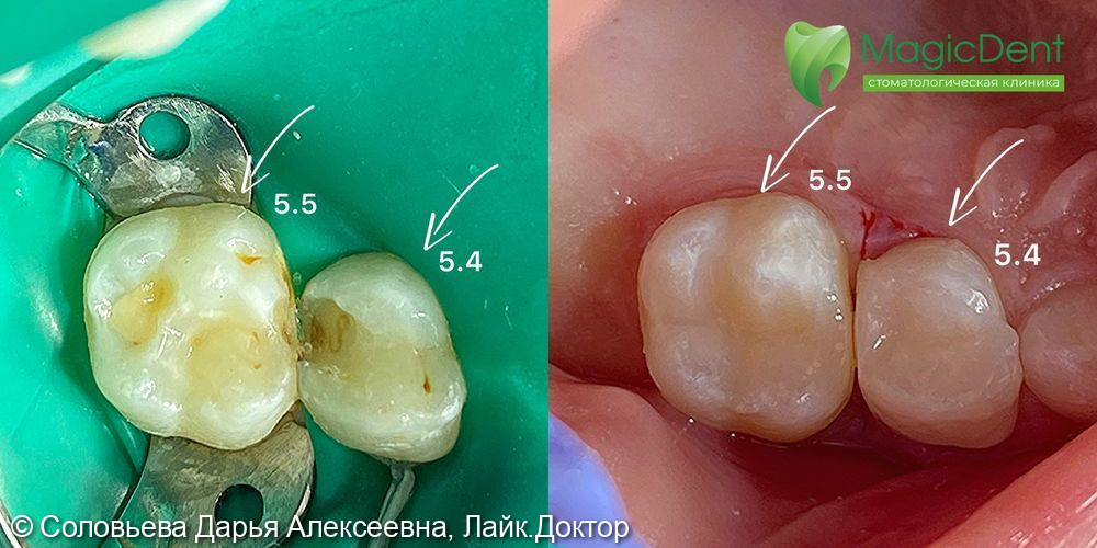 Клиническая ситуация лечения кариеса и пульпита 5.4 и 5.5 зубов (молочных) у девочки 5 лет   - фото №2
