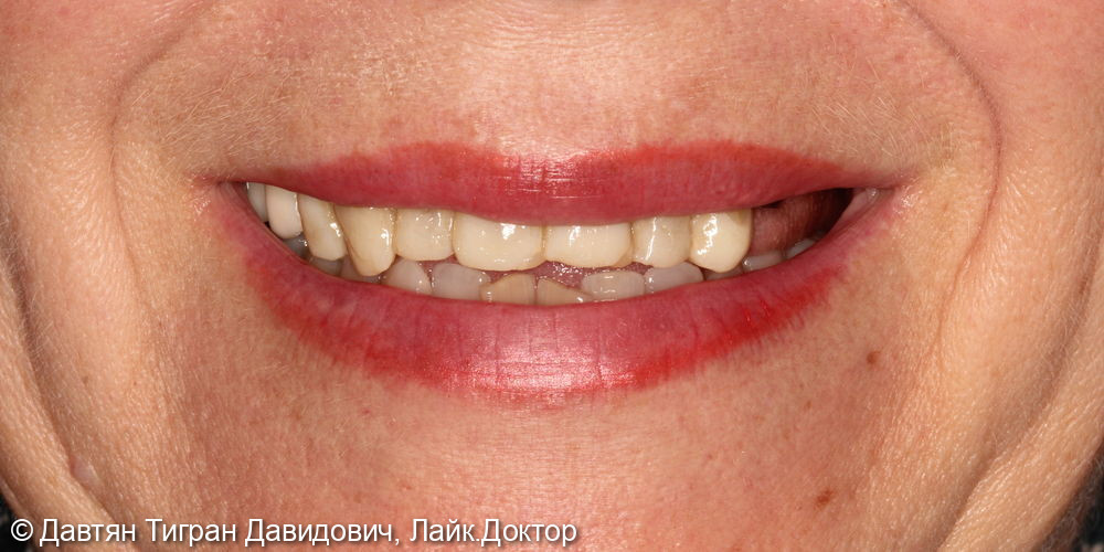 Имплантация и протезирование зубов винирами - фото №1