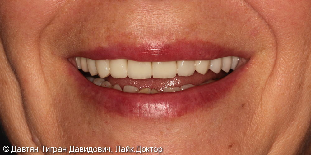 Имплантация и протезирование зубов винирами - фото №2