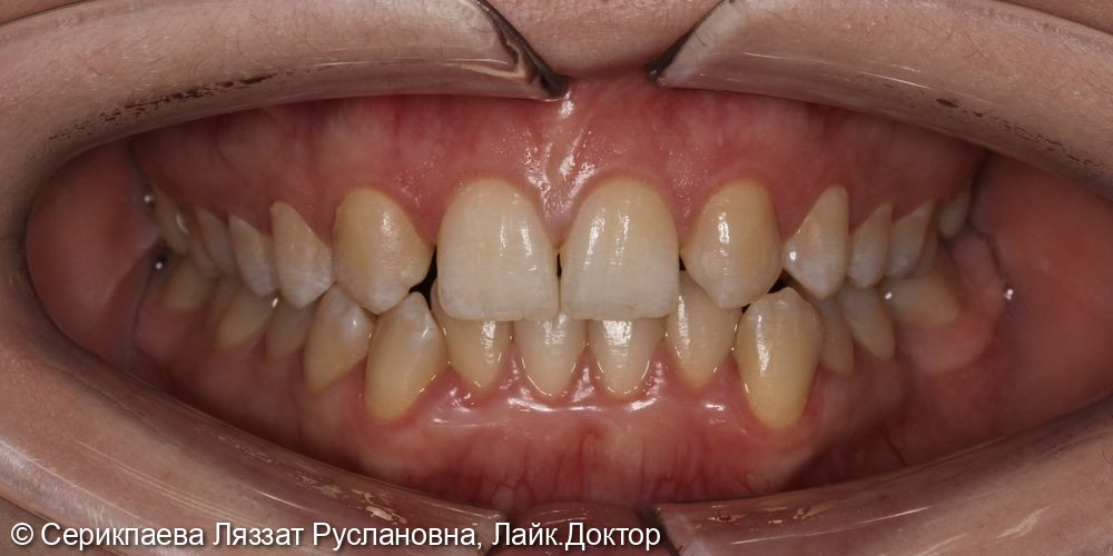 Ортодонтическое лечение на брекет-системе - фото №1