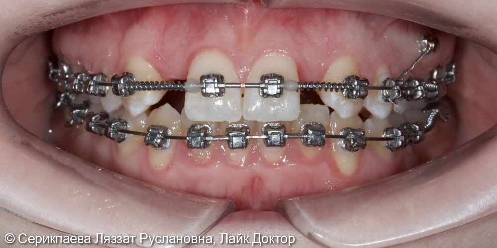 Ортодонтическое лечение на брекет-системе - фото №2