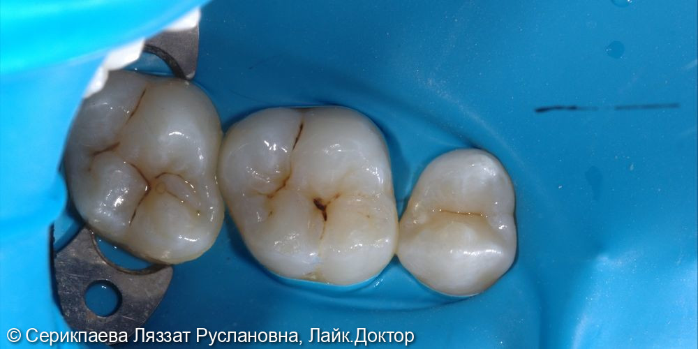 Лечение среднего кариеса на постоянном зубе 1.6 - фото №1