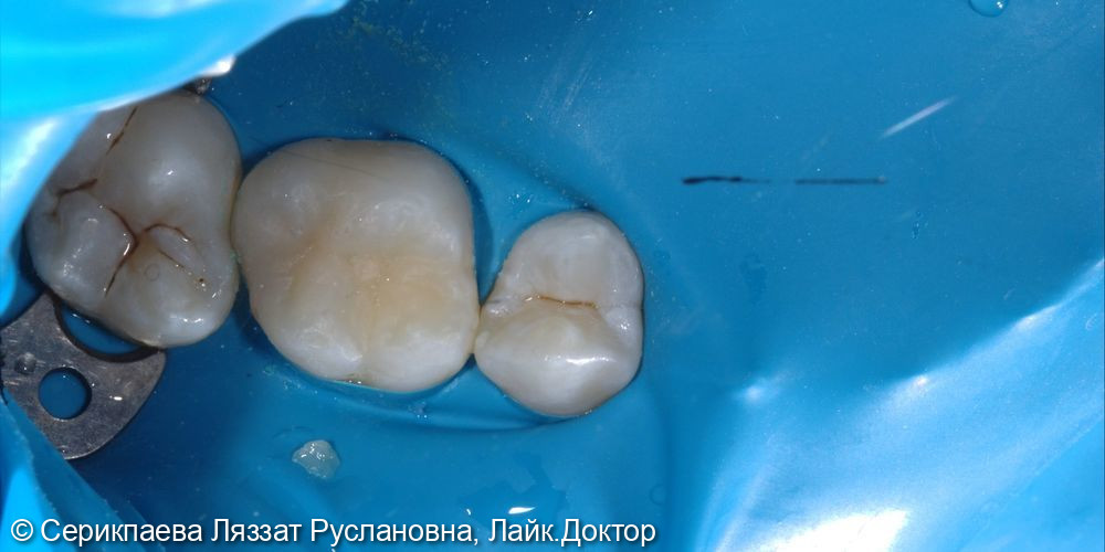 Лечение среднего кариеса на постоянном зубе 1.6 - фото №2