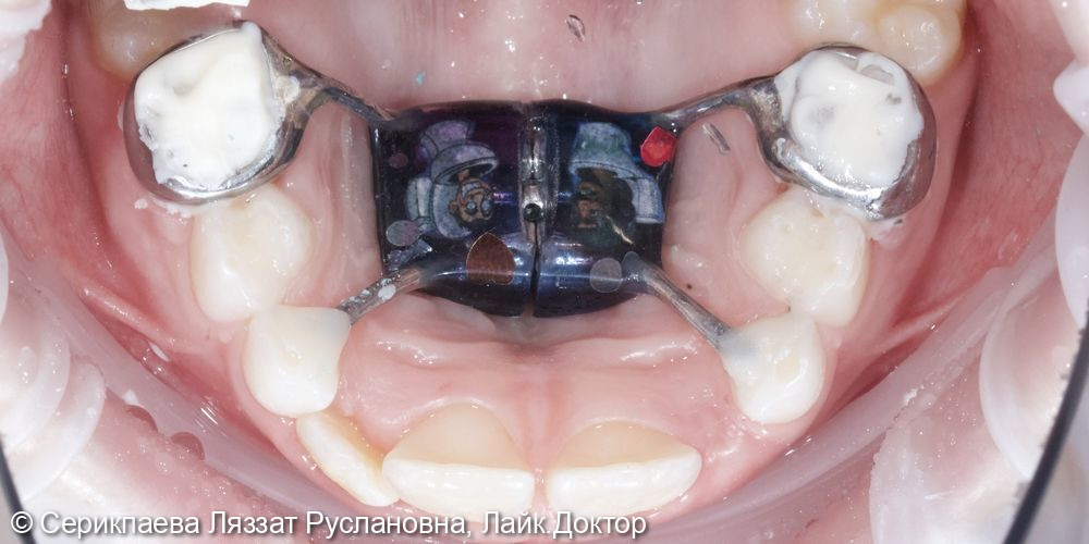 Ортодонтическое лечение аппаратом Хаас по Марко Росса - фото №2