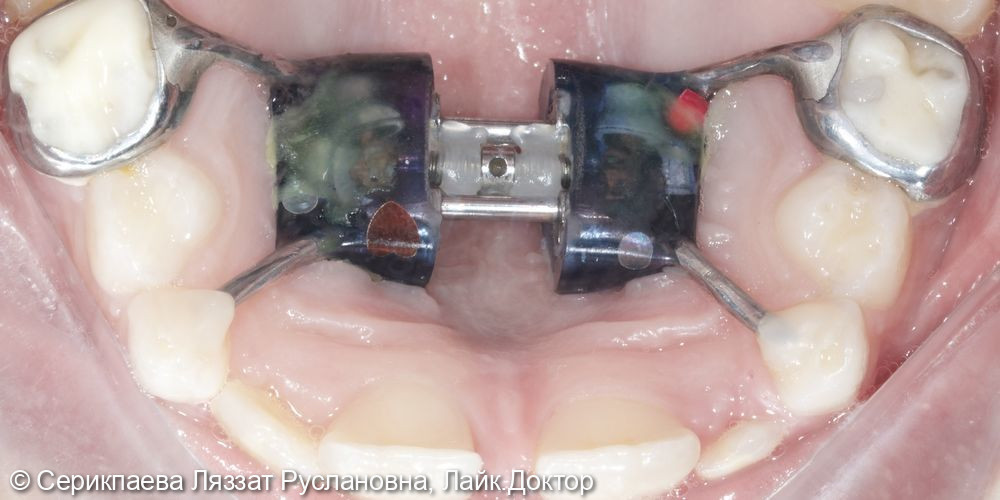 Ортодонтическое лечение аппаратом Хаас по Марко Росса - фото №3