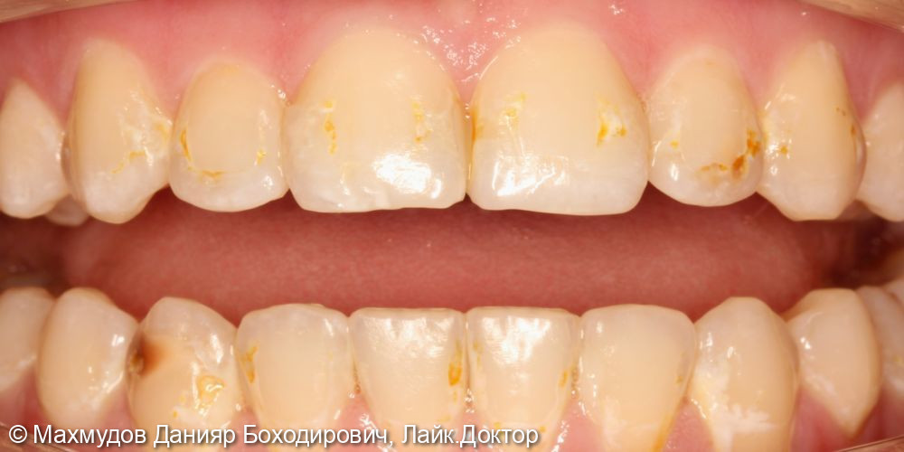 реставрация зубов и лечение кариеса - фото №1