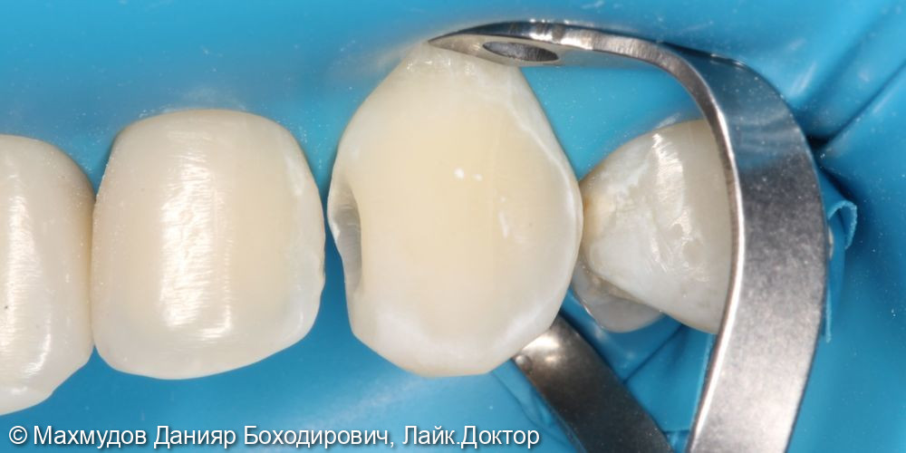 реставрация зубов и лечение кариеса - фото №4