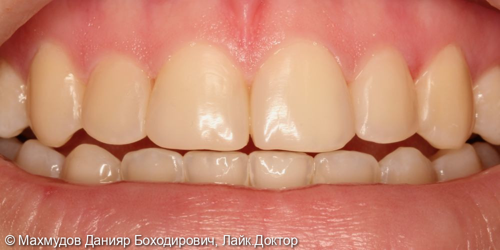 реставрация зубов и лечение кариеса - фото №6