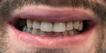Восстановление зубов керамической вкладкой и керамическим виниром - фото №2
