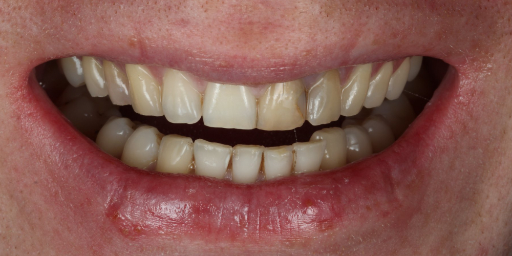 Неудовлетворительный эсететический вид центральных зубов - фото №1