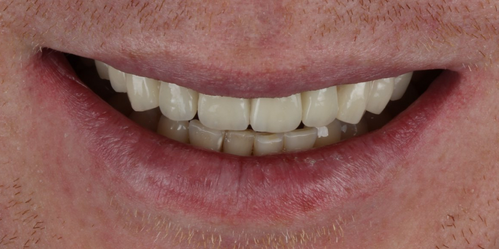 Неудовлетворительный эсететический вид центральных зубов - фото №2
