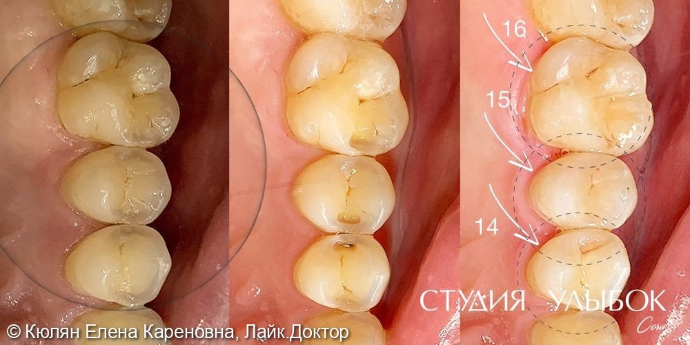 Клинический случай лечения кариеса на контактных поверхностях зубов 14,15,16 - фото №1