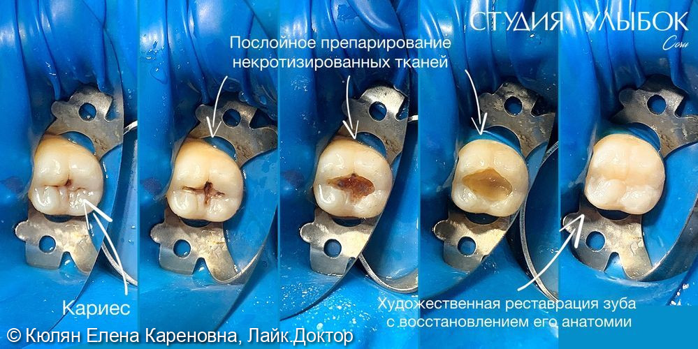Клинический случай лечения кариеса дентина зуба 37 - фото №1
