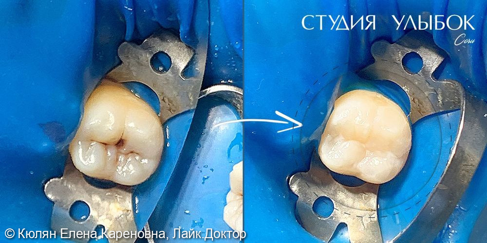 Клинический случай лечения кариеса дентина зуба 37 - фото №2