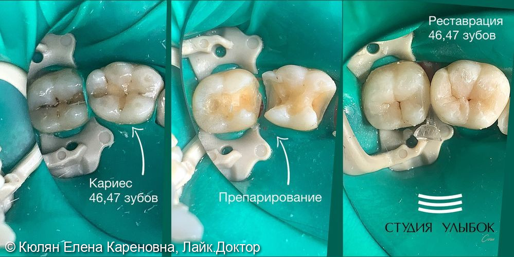 Лечение кариеса 46, 47 зубов - фото №2