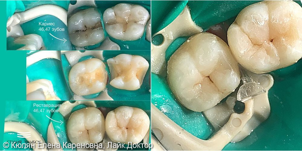 Лечение кариеса 46, 47 зубов - фото №3
