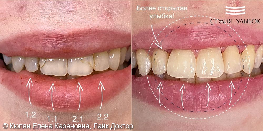 Лечение кариеса дентина фронтальной группы зубов (21,22,11,12) - фото №1