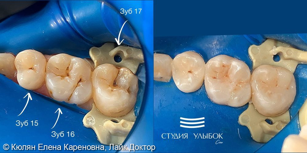 Восстановление полной анатомии зубов 17,16,15 при лечении кариеса - фото №1