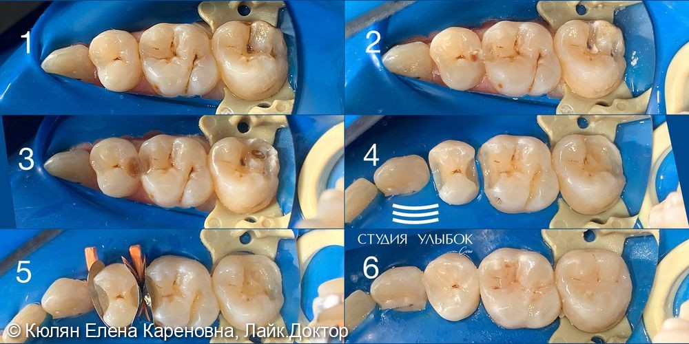 Восстановление полной анатомии зубов 17,16,15 при лечении кариеса - фото №2
