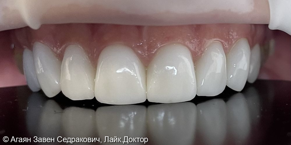 Восстановление фронтальных зубов с помощью керамических виниров - фото №1