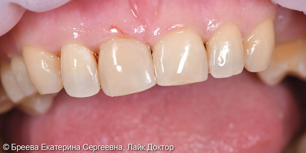 Лечение переднего зуба 11 - фото №2