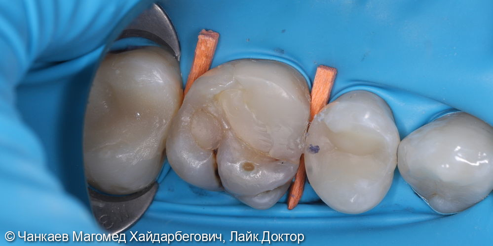 Перелечивание зуба 26 и восстановление зуба под коронку - фото №1