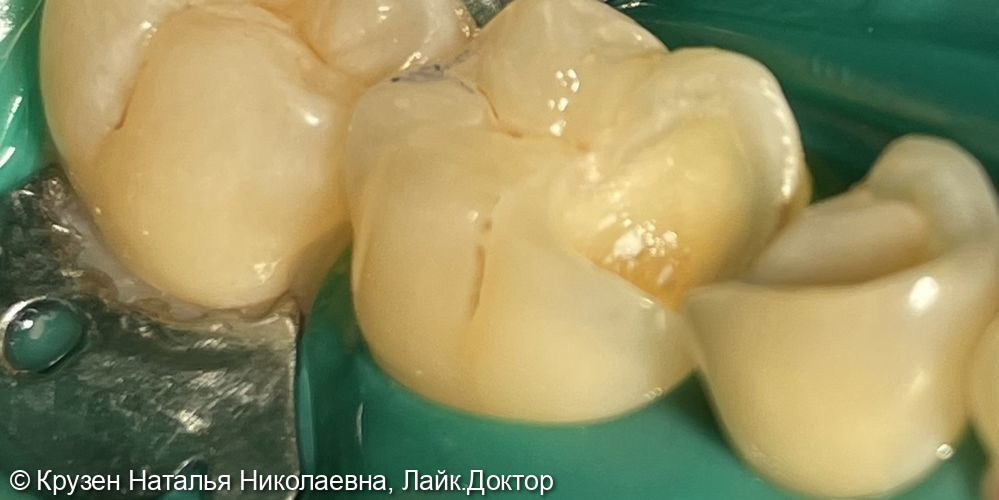 Лечение Глубокого кариеса 4.6; хронического периодонтита 4.5 - после
