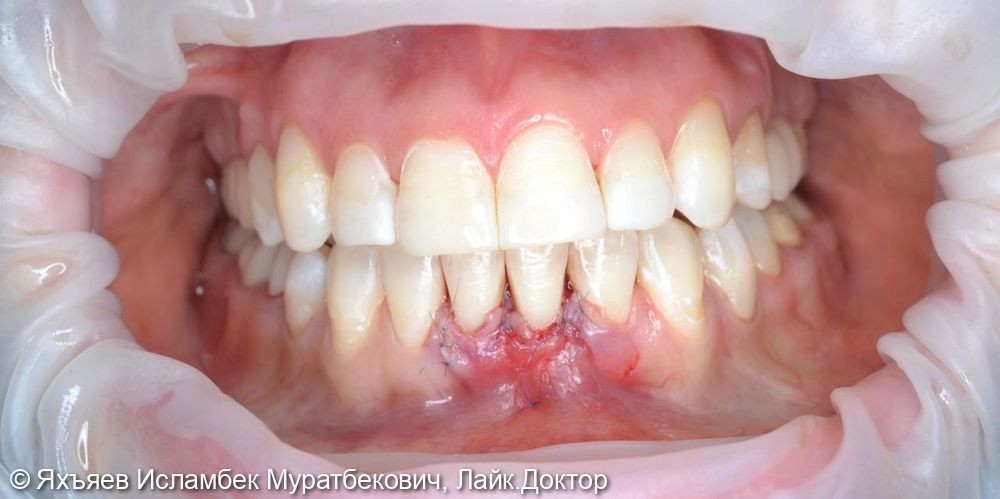 Лечение оголения корней зубов в следствии рецессии десны - фото №2