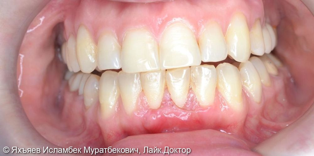 Лечение оголения корней зубов в следствии рецессии десны - фото №3