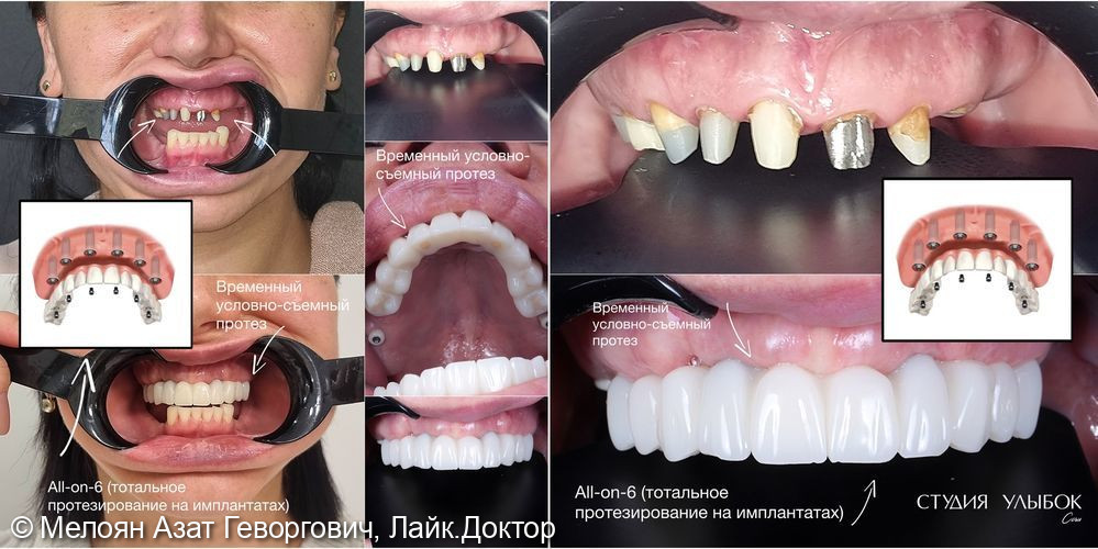 Одномоментное удаление зубов и установка 6 имплантатов под наркозом - фото №1