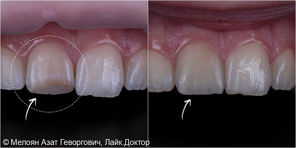 Высокохудожественная реставрация зуба 11 - фото №5