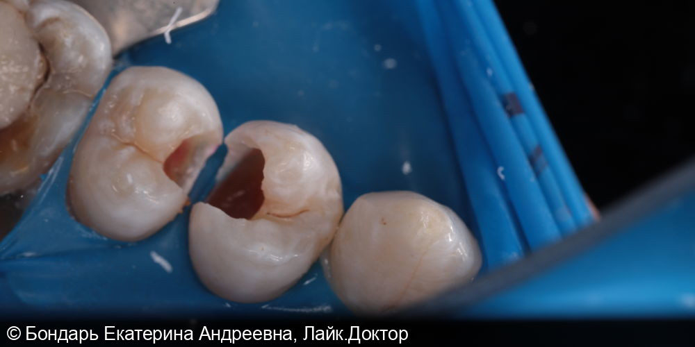 Лечение кариеса 24,25 зубов фото 2 · Вологда