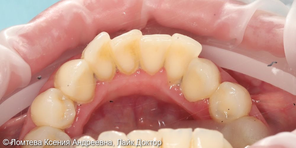 Профессиональная гигиена зубов - фото №3