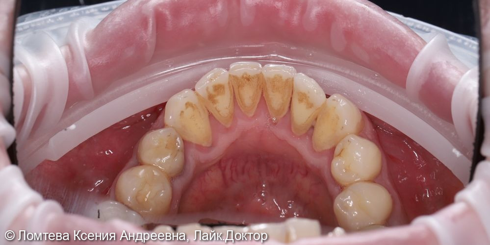 Профессиональная гигиена зубов - фото №2